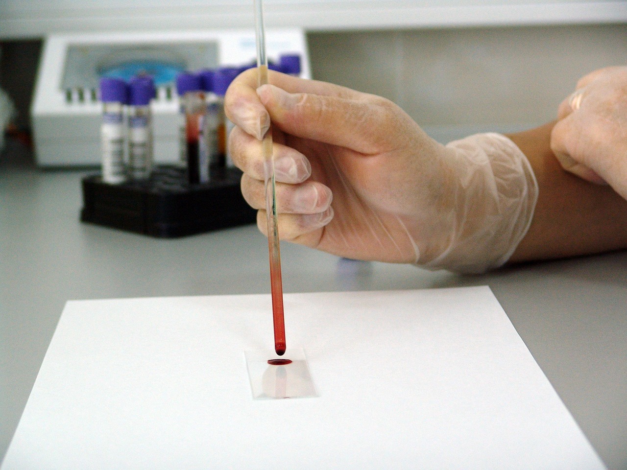 sample, lab, laboratory, medical, drop, glass, research, hospital, biology, experiment, scientist, analyzing, liquid, glove, test, medicine, healthcare, science, analysis, scientific, doctor, clinic, clinical